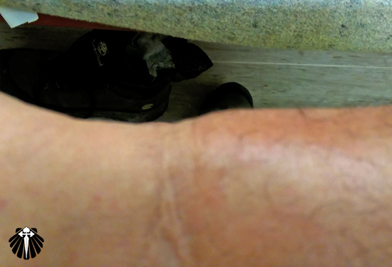 E depois de cinco etapas... Uma tendinite para carregar até Santiago de Compostela! Thumb