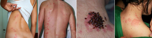 Picadas de Chinches Picadas de Chinches